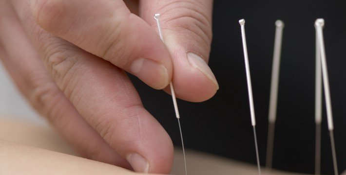 Testez l'acupuncture pour arrêter de fumer