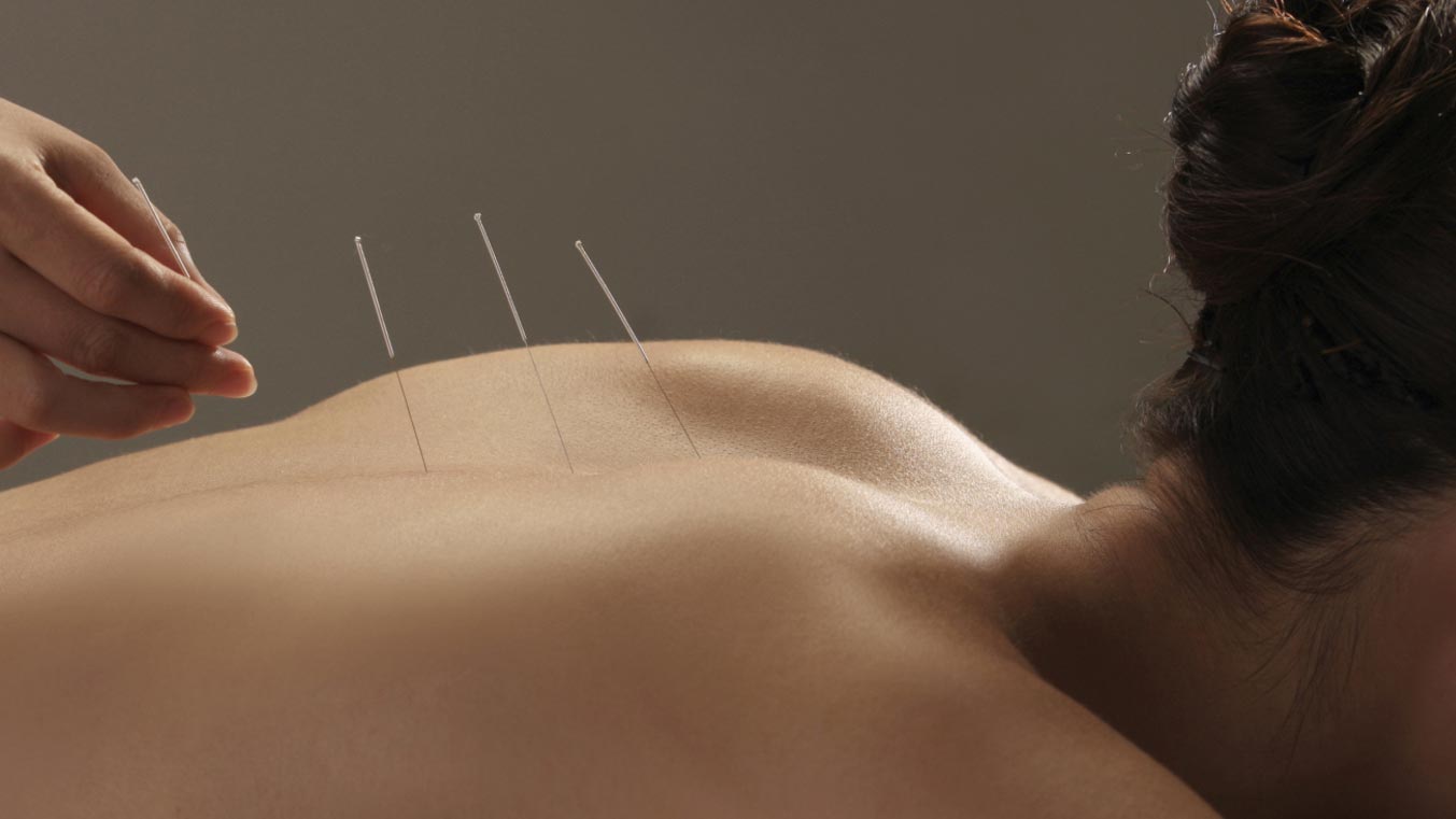 Acupuncture pour maigrir