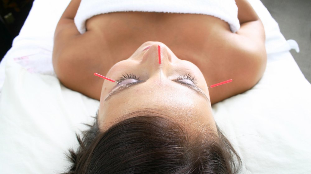 Les points d'acupuncture