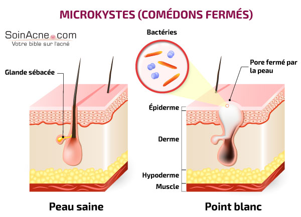 les-microkystes